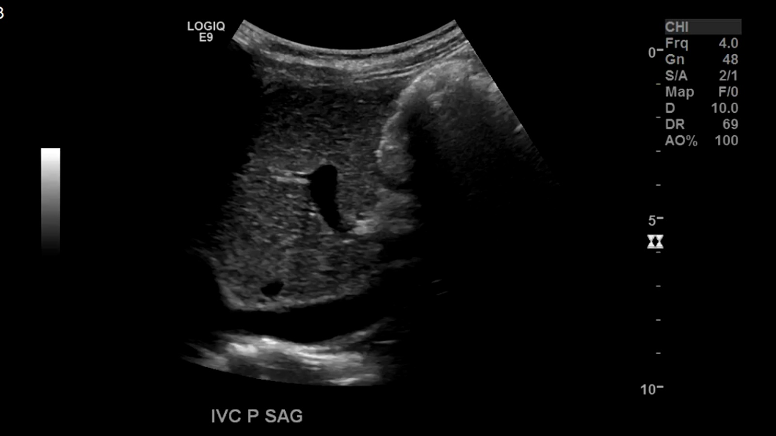 IVC prox sagittal gray-scale