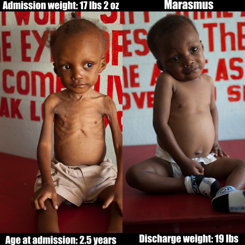 marasmus