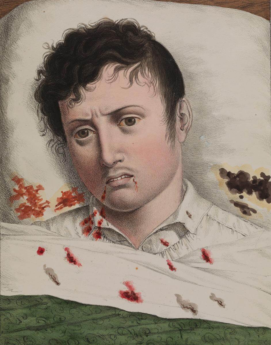 Development of yellow fever 4. Illustration originally published in Etienne Pariset and André Mazet's Observations sur la fièvre jaune, faites à Cadix, en 1819. Courtesy of Wikimedia Commons. Creative Commons license CC BY 4.0.