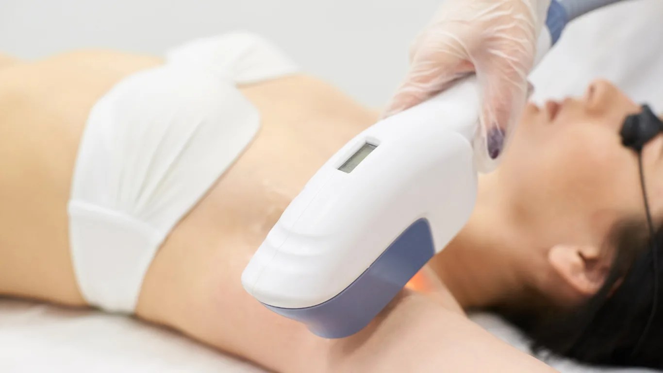 laser hair removal