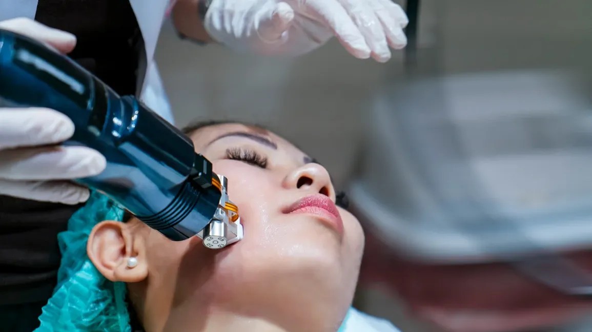 rf treatment