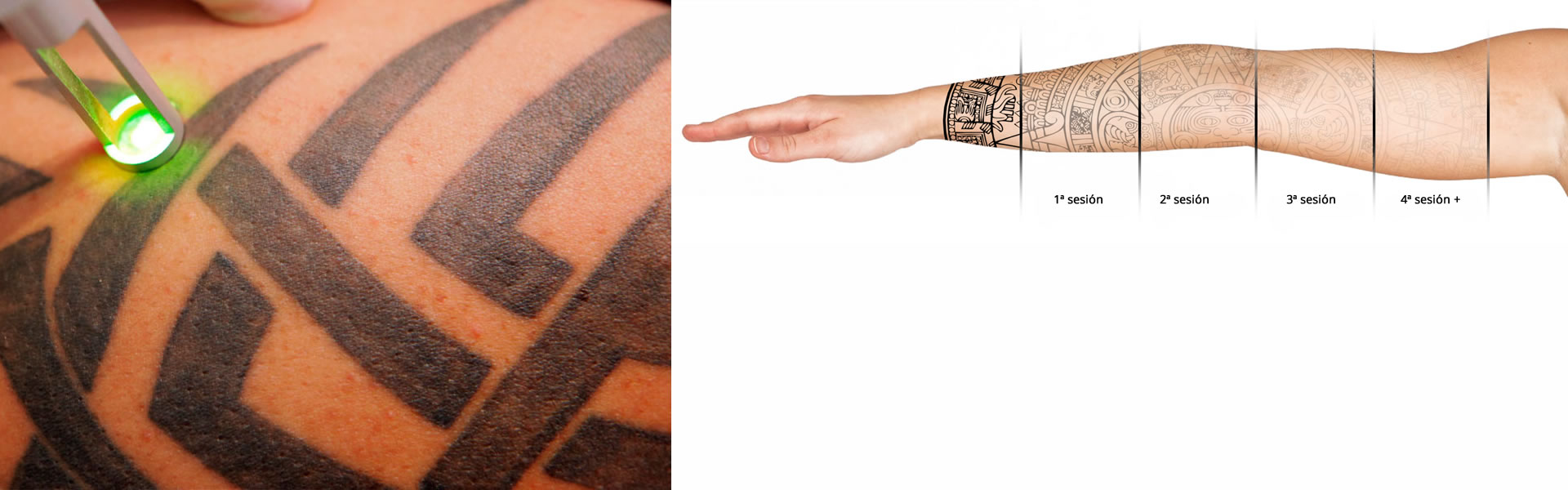 Como Funciona Spectra Tattoo Laser