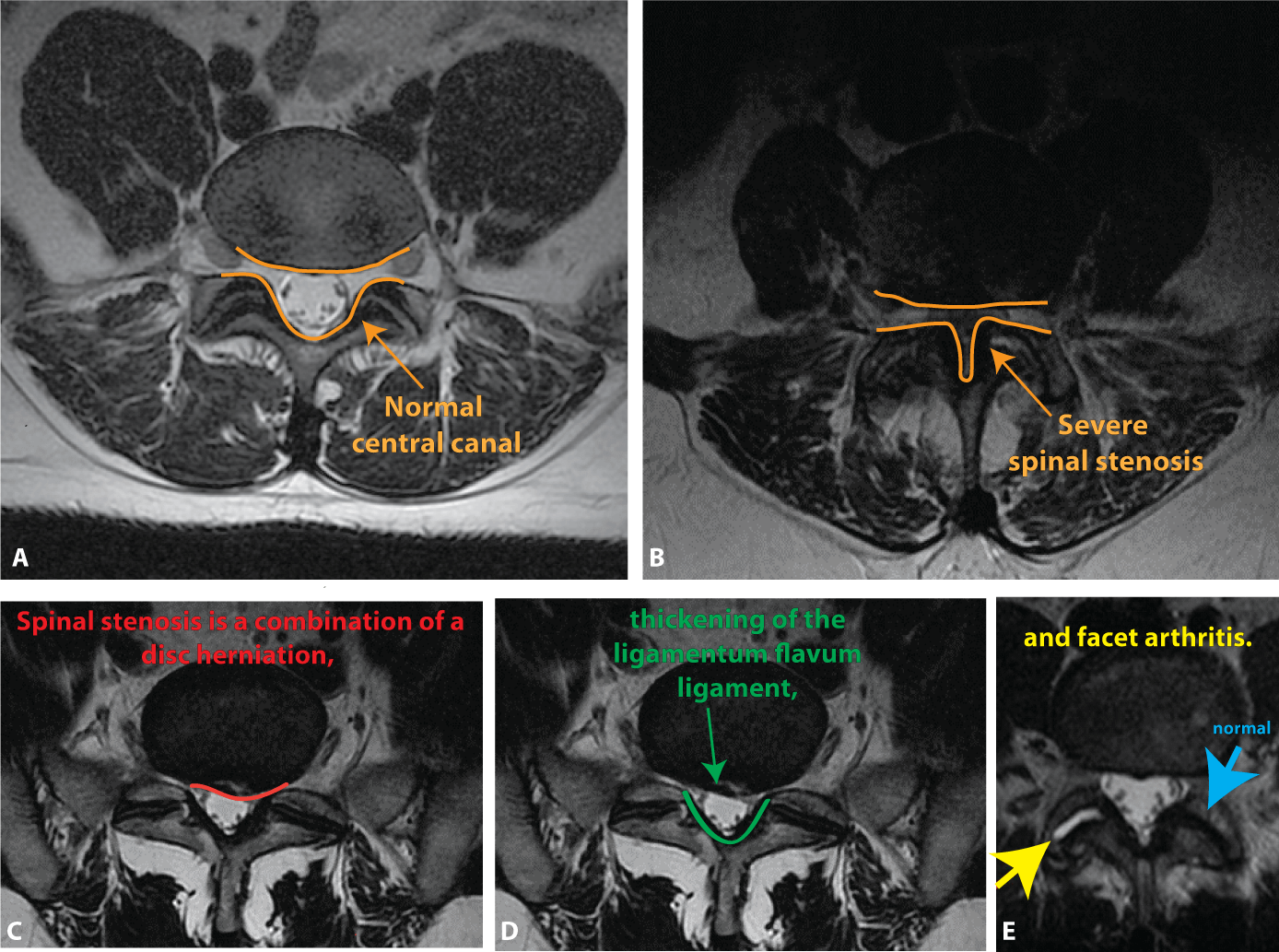 How To Understand Your Complex Spine MRI in 8 Easy Steps | Healthcare
