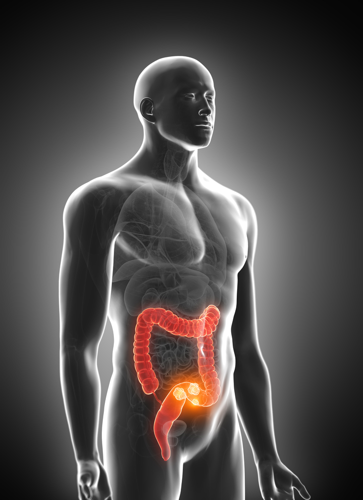 New screening guidelines issued for colorectal cancer | Minnesota