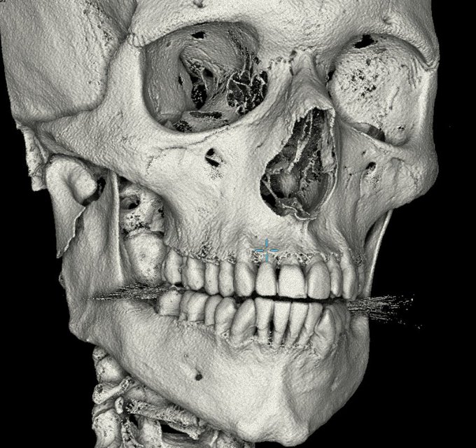 AEW Star Suffers Broken Jaw
