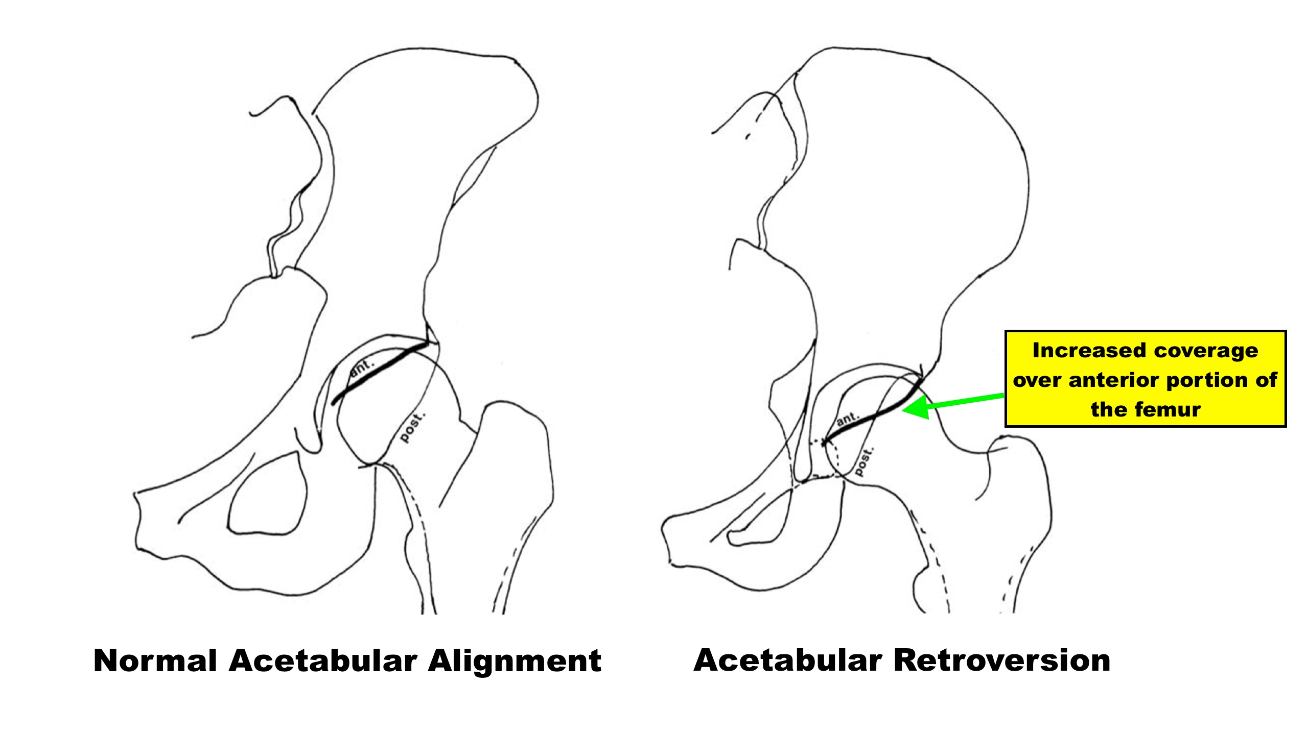 Fixing Hip Impingement Squat University