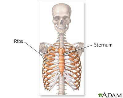 A tumor is any type of abnormal growth of cells, whether malignant . Pectus Excavatum Information Mount Sinai New York