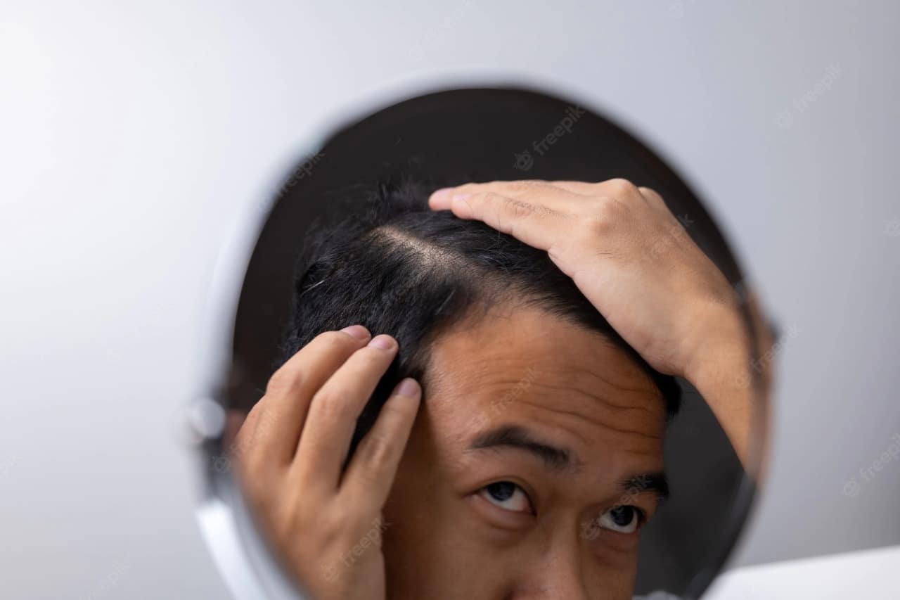 alopecia