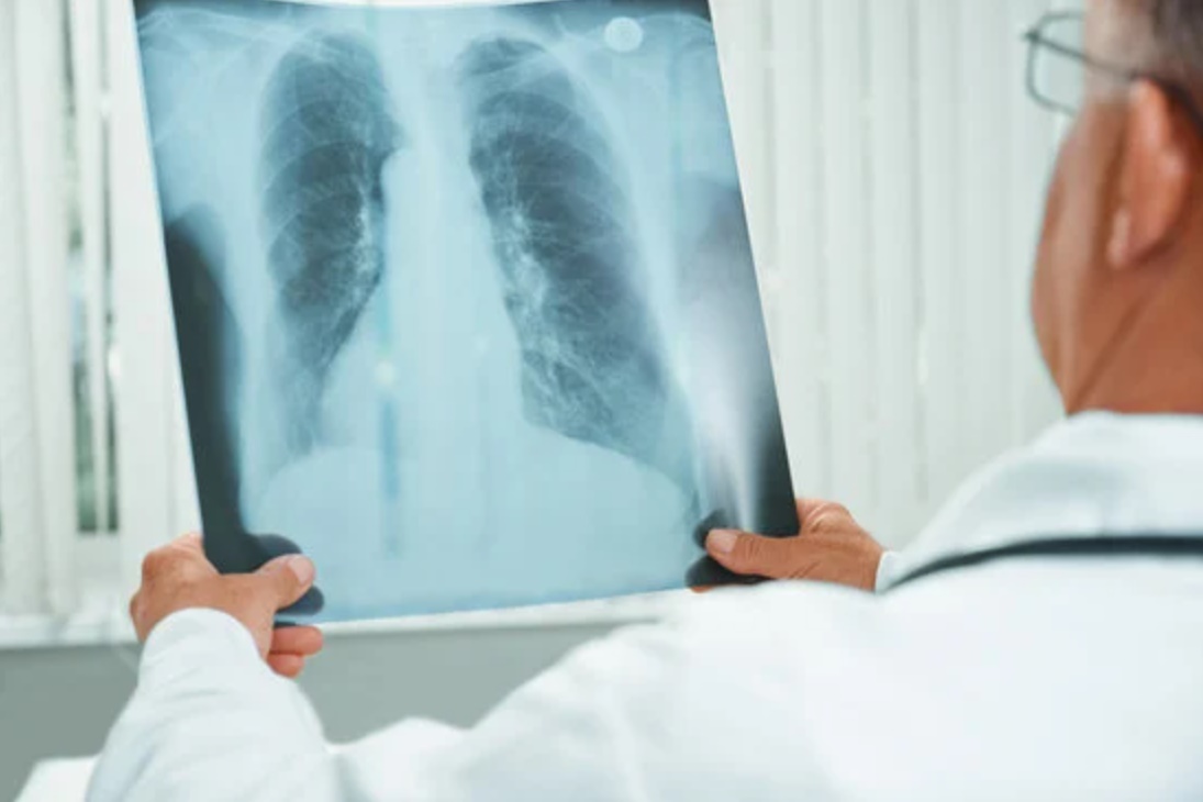 Dia Mundial da Tuberculose