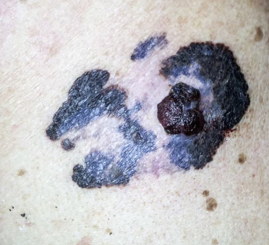 Dia Europeu do Melanoma
