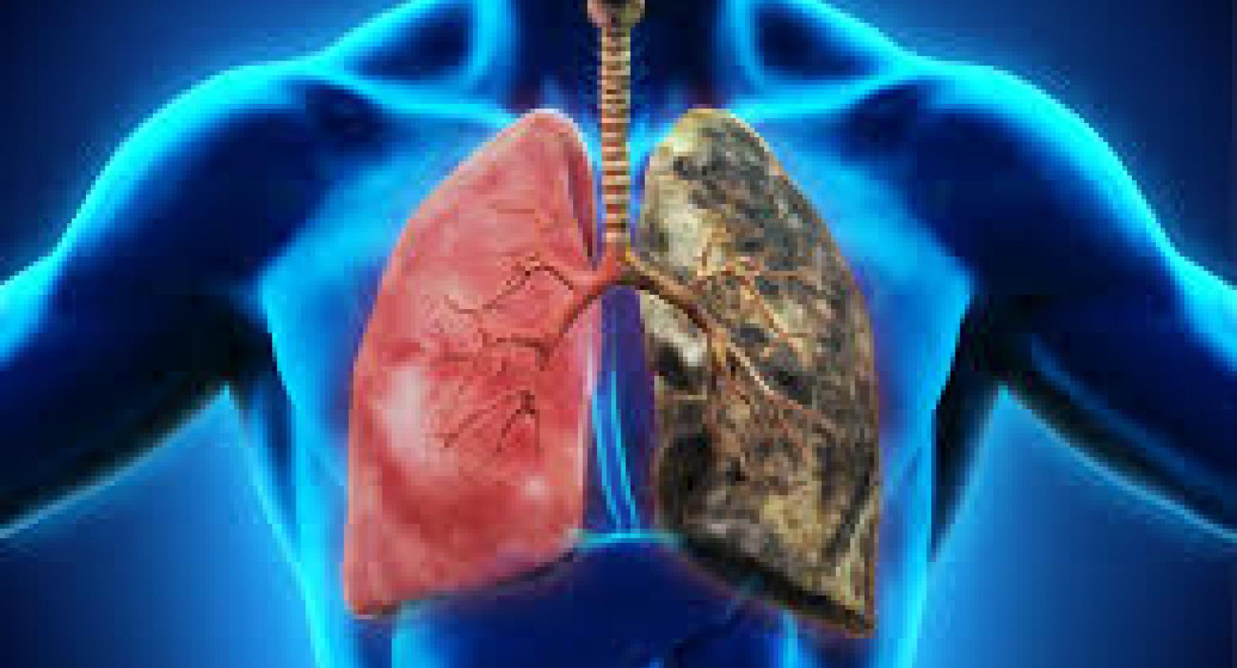 Do We Know How Smoking Causes Lung Cancer? November Is Healthy Lung