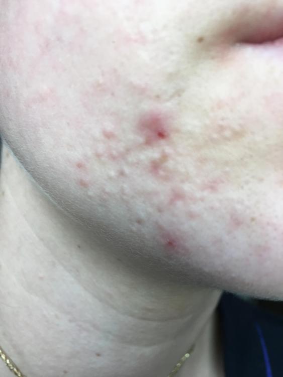 Papules are closed redsome pimples may be there for a very short period of time and you would not worry much about this. Small Flesh Colored Bumps on Forehead and Hairline - Adult