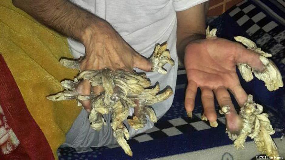 داء اليد والقدم والفم hand, foot and mouth disease هو مرض فيروسي شائع يصيب الرضع والأطفال عادةً ولكن من الممكن أن يصيب البالغين؛ إذ يميل . Ø¹ÙØ± ÙØªØ­ÙÙ Ø¥ÙÙ Ø´Ø¬Ø±Ø© Ø¨Ø³Ø¨Ø¨ ÙØ±Ø¶ ÙØ§Ø¯Ø± ÙÙÙØ¹Ø§Øª ÙØ§ÙØ°Ø© Dw Ø¹Ø±Ø¨ÙØ© Ø¹ÙÙ Ø­ÙØ§Ø© Ø§ÙÙØ´Ø§ÙÙØ± ÙØ§ÙØ£Ø­Ø¯Ø§Ø« Ø§ÙØ·Ø±ÙÙØ© Dw 06 02 2018