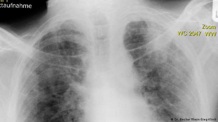 Cancerul pulmonar este responsabil pentru aproape unul din cinci decese cauzate de cancer la nivel mondial, provocand peste 1,6 milioane de decese in fiecare an. Curs Sever Al Bolii Covid 19 De La O FormÄ FizicÄ PerfectÄ La Un Pas De Moarte Societate Dw 20 11 2020
