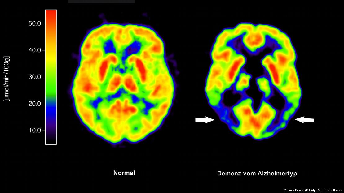 Comparación entre dos cerebros: uno sano (izquierda) y otro con la enfermedad de Alzhéimer.