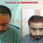 Hair transplant result