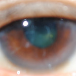Mystic, Divine right eye-pupil-retina-cornea of Judge Florentino Floro