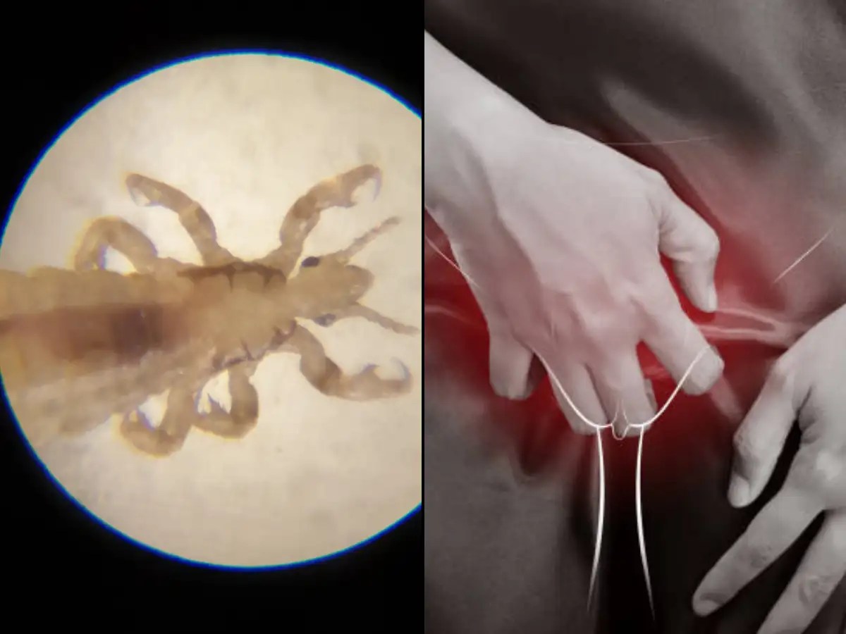 Sexual health: Signs you have pubic lice and how to get rid of it | The Times of India