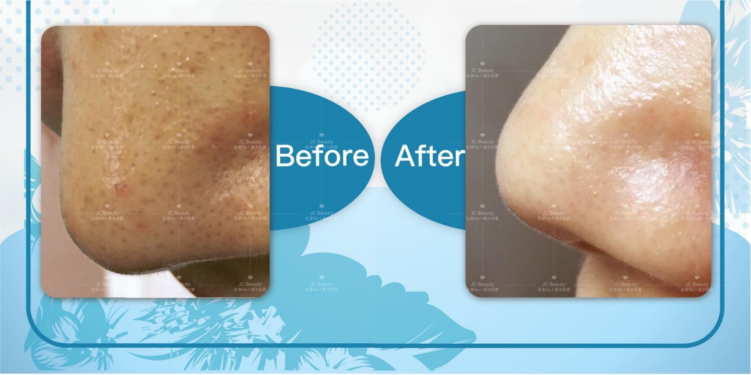 眼紅筋知多啲 以為是眼攰 Nqnpg