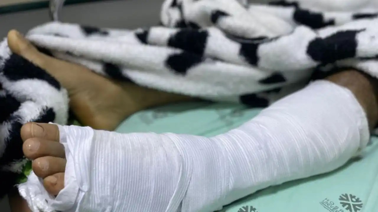 Alerta nacional: En solo horas, los quemados por pólvora pasaron de 1.313 a 1.419