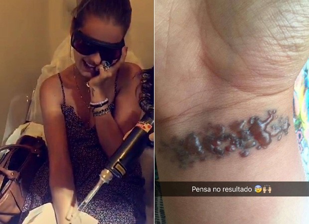 Bolhas apos remocao de tatuagem Cromma Laser Resultados