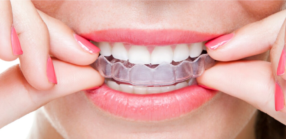 Auf Invisalign Singapore In terms of the cost of Invisalign.