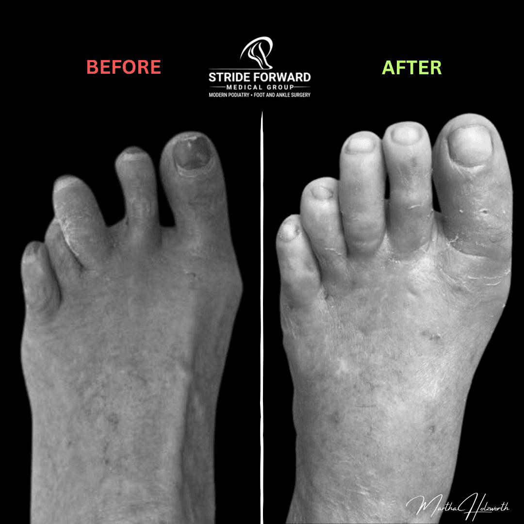 hammertoe operation