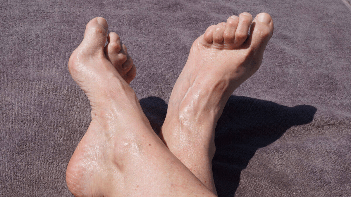 hammertoe surgery