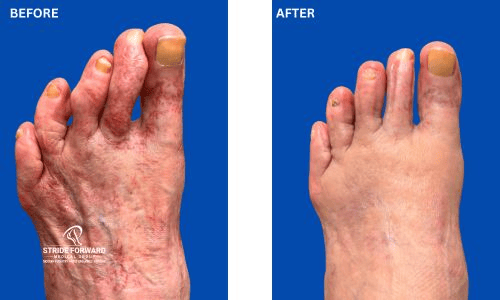 BEFORE & AFTER hammertoe revision surgery