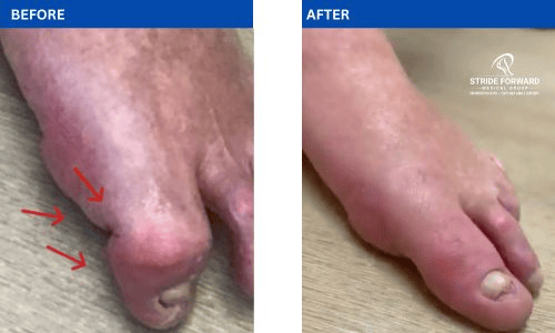 Hallux Malleus before and after