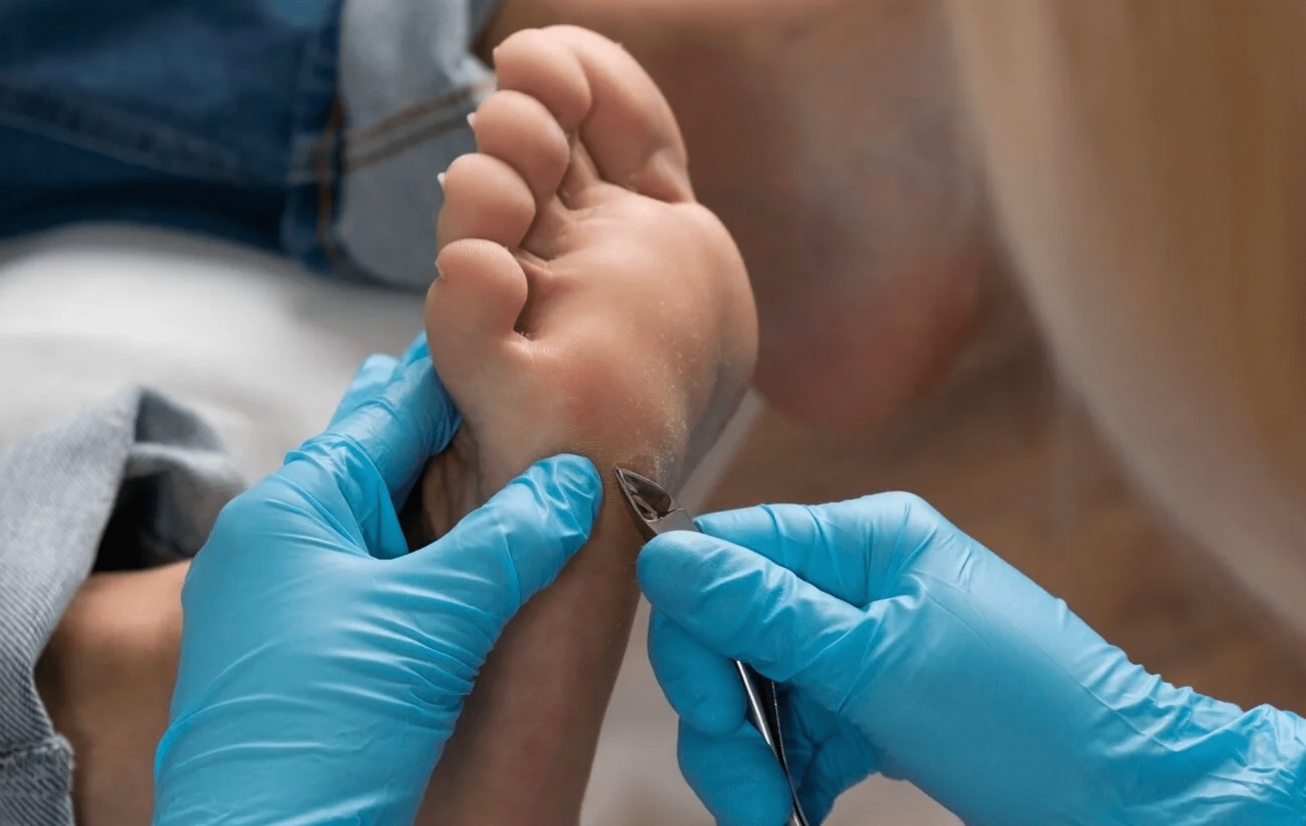 Foot Callus Treatment