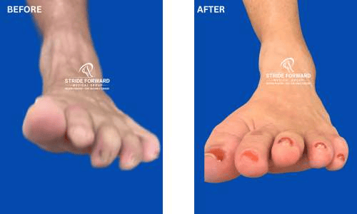 hammertoes