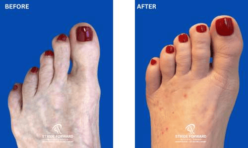 lesser toe realignment