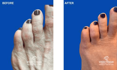 pinky toe hammertoe correction
