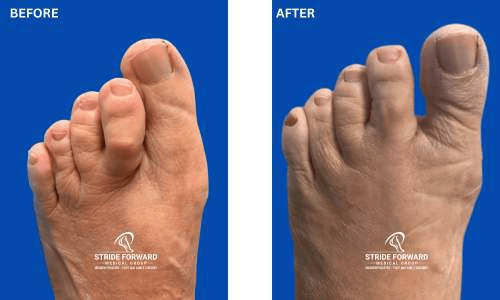 second toe hammertoe and mild bunion