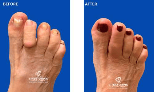 second toe hammertoe correction