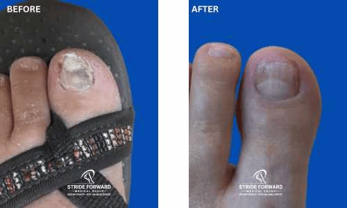 before and after nail infection