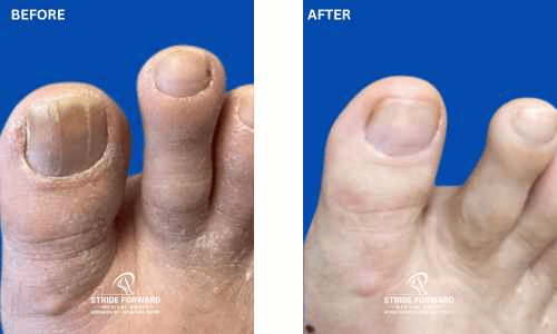 before and after nail infection