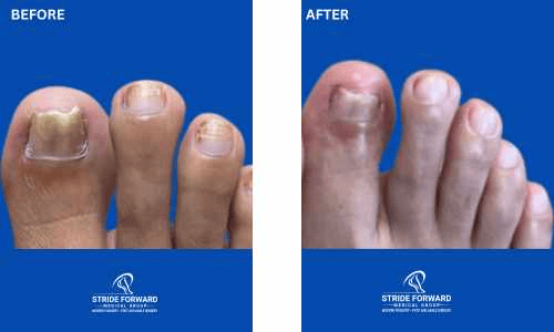 before and after nail infection