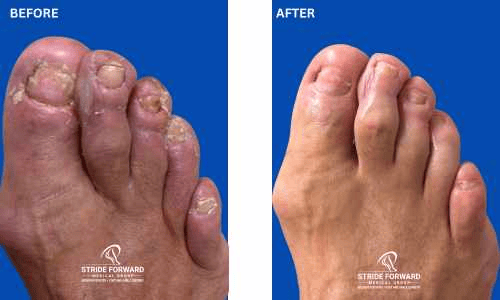 before and after nail infection