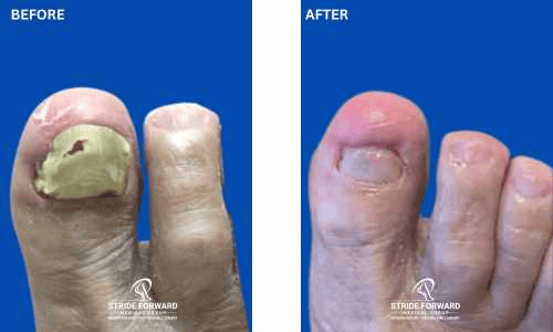 before and after nail infection