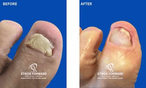 before and after nail infection