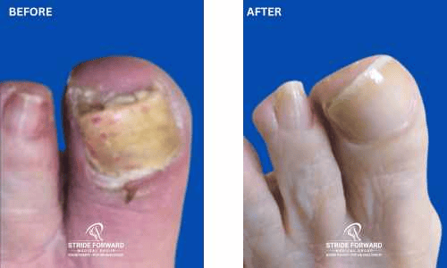 before and after nail infection
