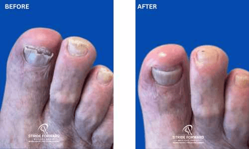 before and after nail infection