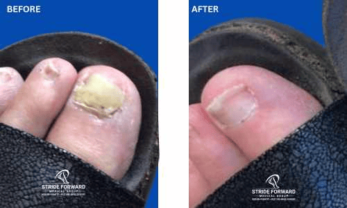 before and after nail infection