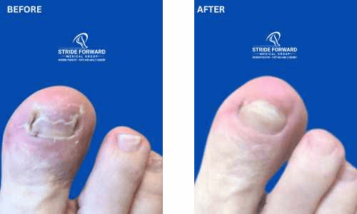 before and after nail infection