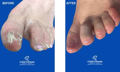 before and after nail infection