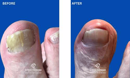 before and after nail infection