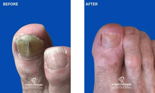 before and after nail infection