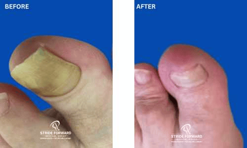 before and after nail infection
